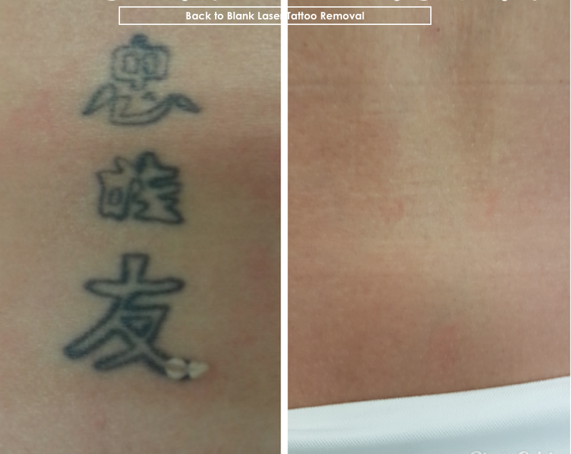 Back To Blank Laser Tattoo Removal In Newtown Au Nsw Vagaro
